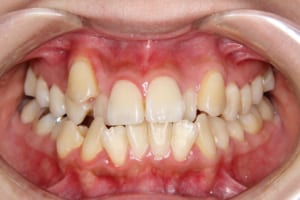 前歯部の叢生が強く八重歯も見られます。